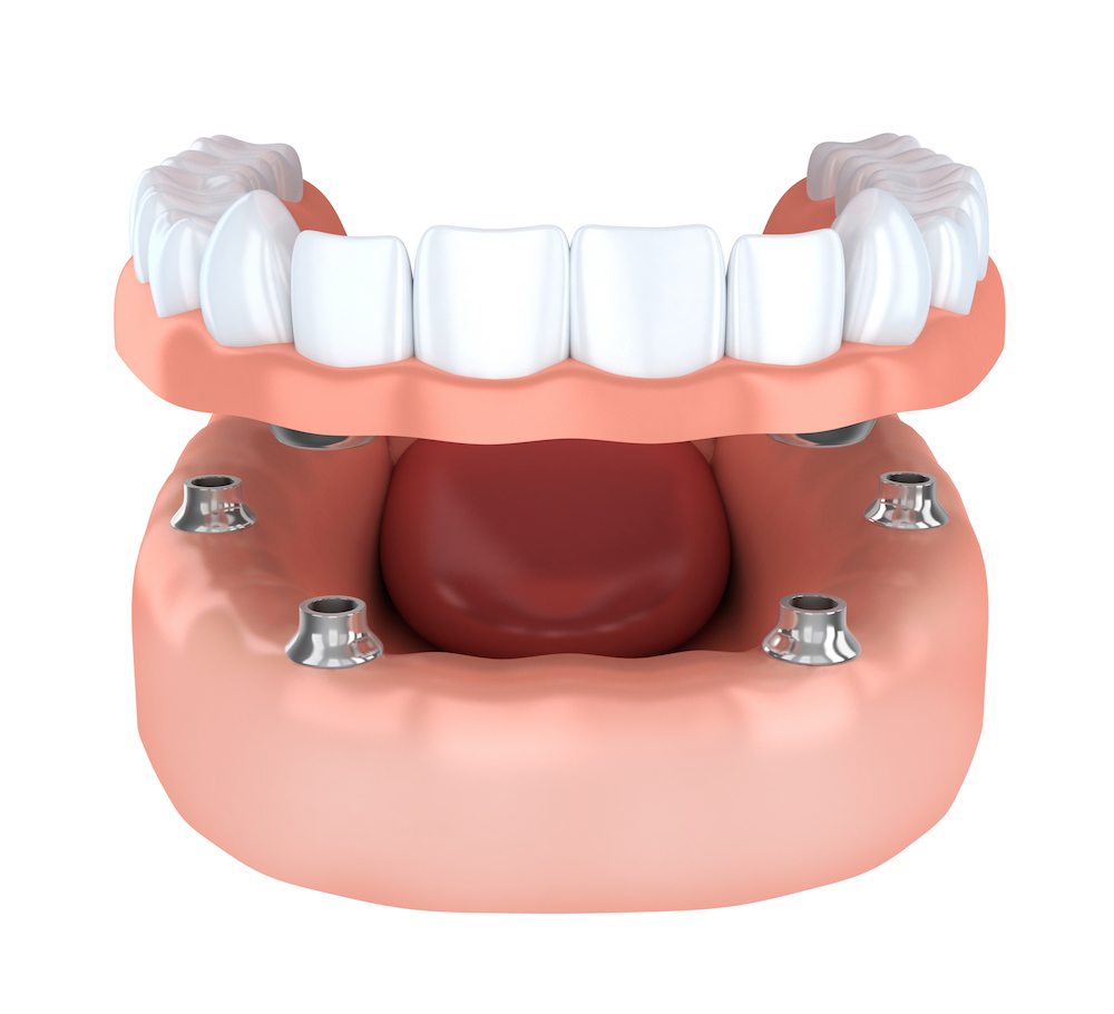Photo of all on 4 fixed implants