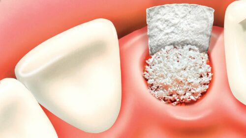 Photo of Bone Grafting