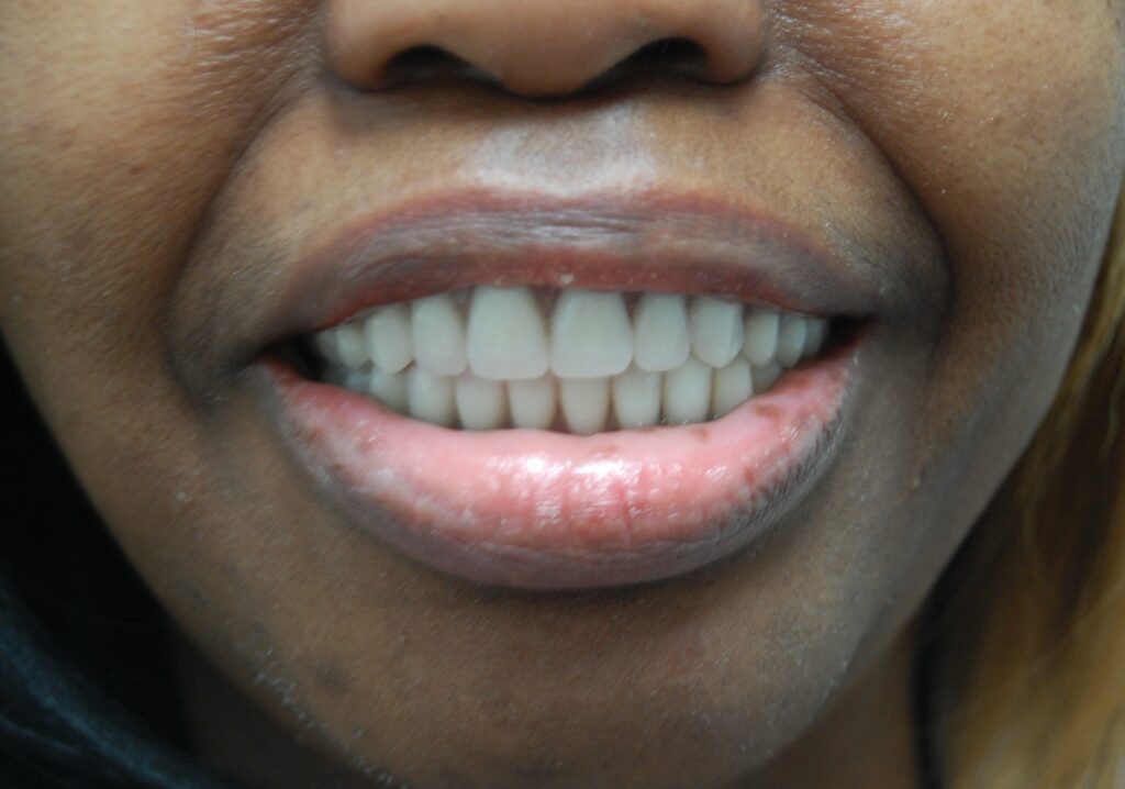 Photo of Snap On Denture Before and After 4