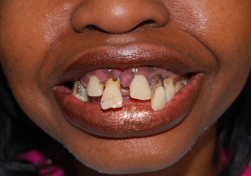 Photo of Snap On Denture Before and After 3