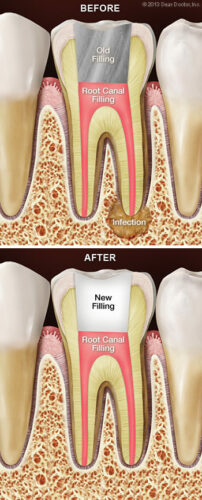 Photo of Before and After Retreatment